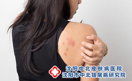 肩膀 癥狀 肩膀 癥狀