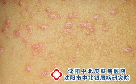 滴狀銀屑病1 滴狀銀屑病1